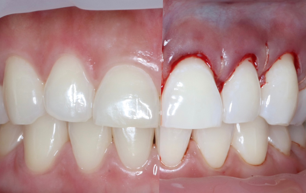 Gingival Aesthetics (ตัดแต่งเหงือก)