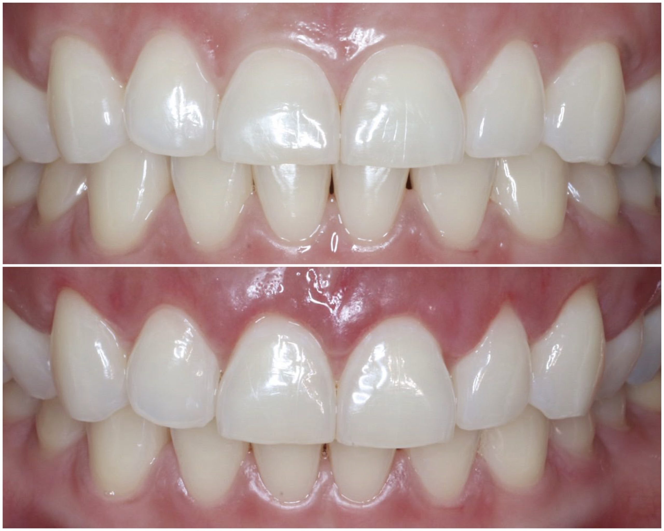 Belix Dental Gummy Smile Treatment
